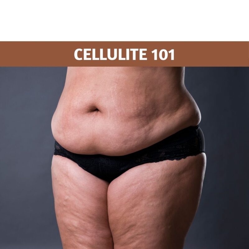 Cellulite