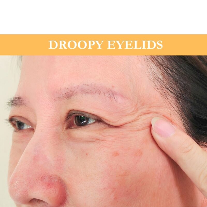Droopy eyelids (Ptosis)