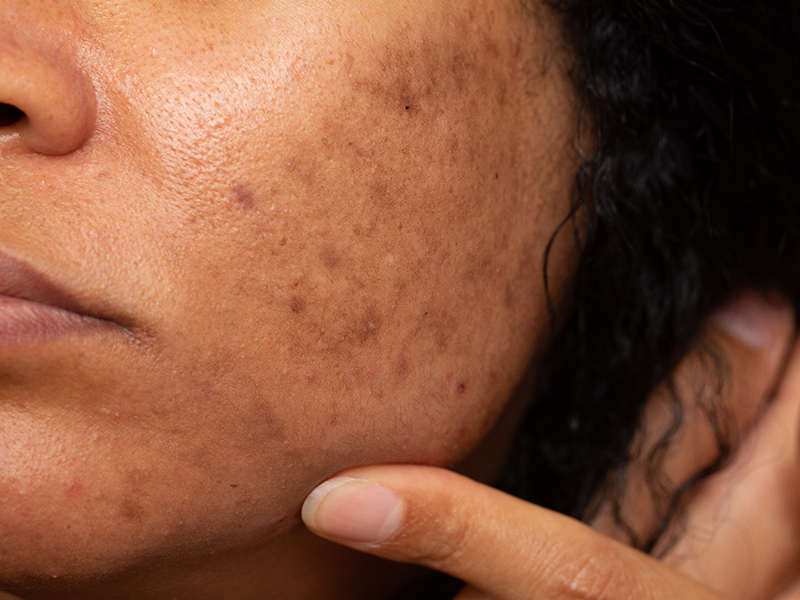 how-to-remove-dark-spots-on-face-fast-naturally