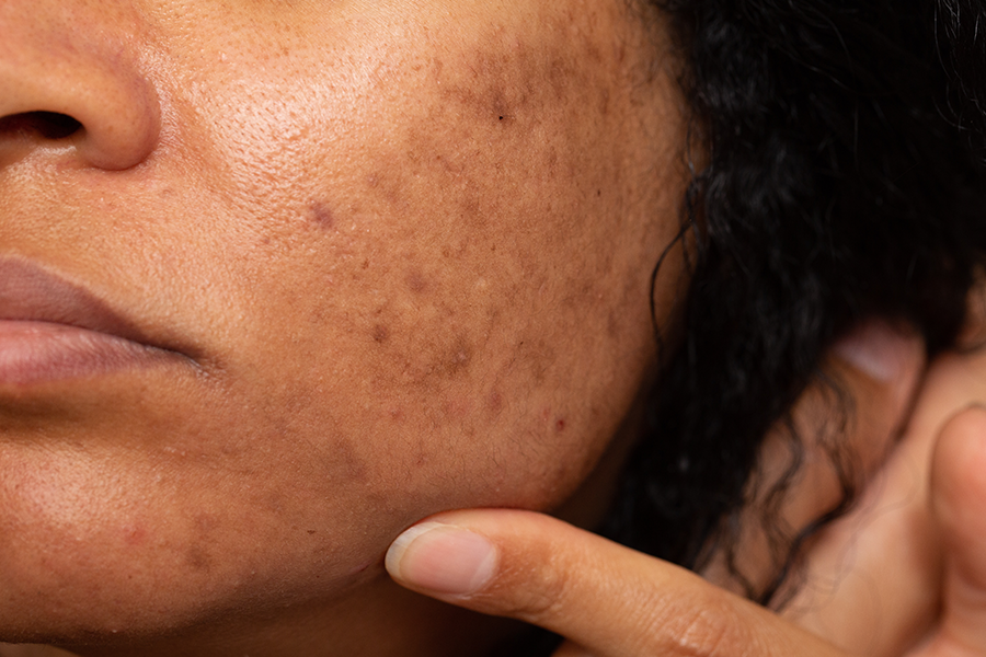 How To Remove Dark Spots On Face Fast Naturally?