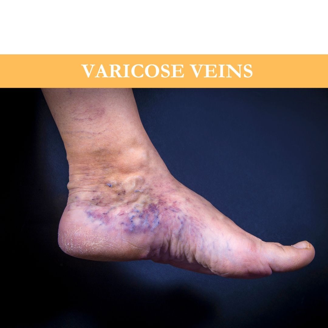 Beneath the Surface: Causes, Stages and Treatments of Varicose Veins