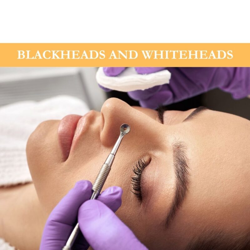 Blackheads and Whiteheads