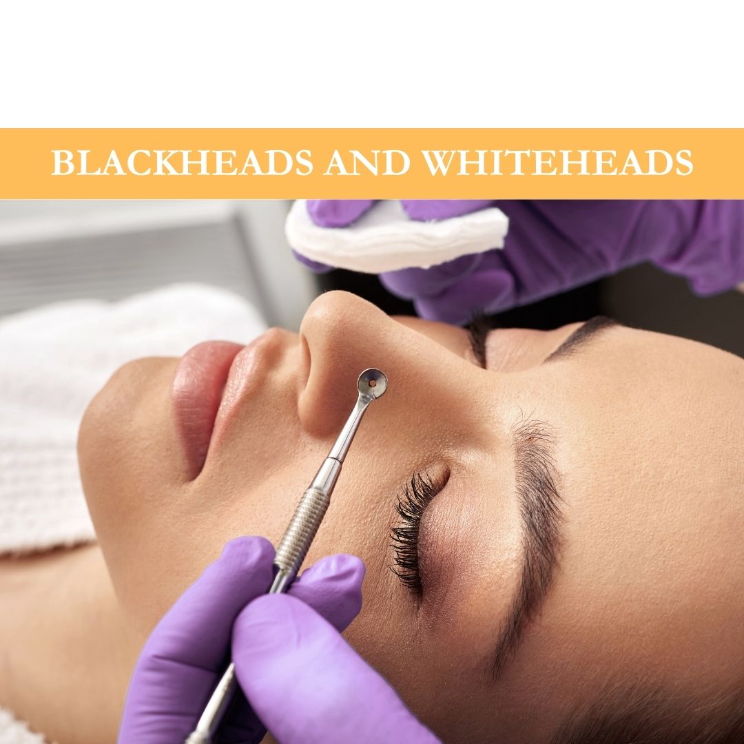 Blackheads and Whiteheads: Difference, Prevention, and Treatment