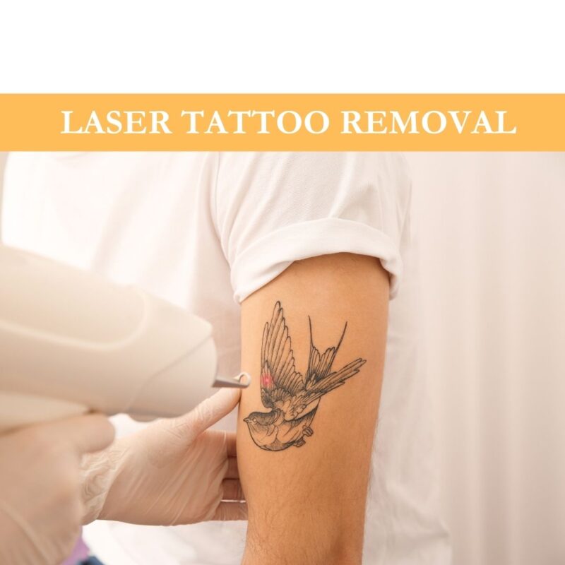 Laser Tattoo Removal