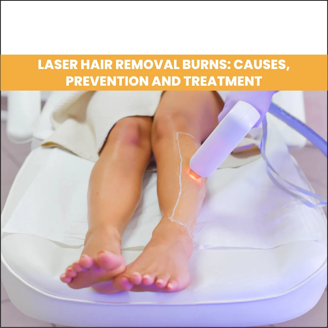 Laser Hair Removal Burns: Causes, Prevention, and Treatment