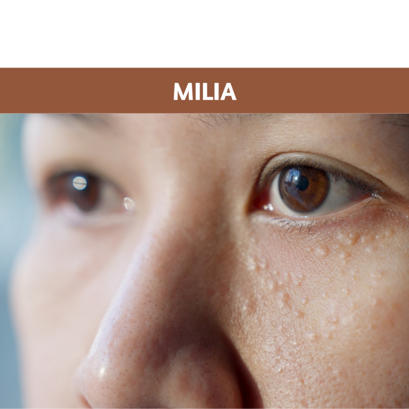 Milia