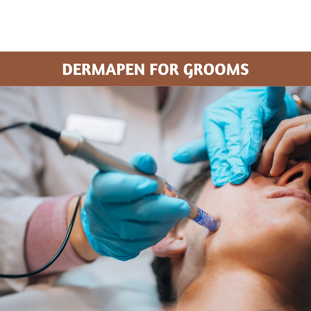 Dermapen for Grooms: The Ultimate Pre-Wedding Skin Treatment