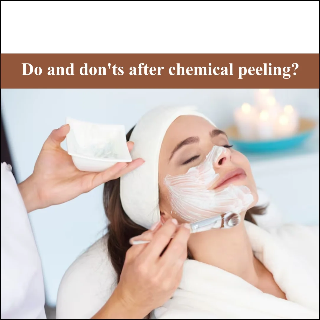 Do and Don’ts After Chemical Peeling