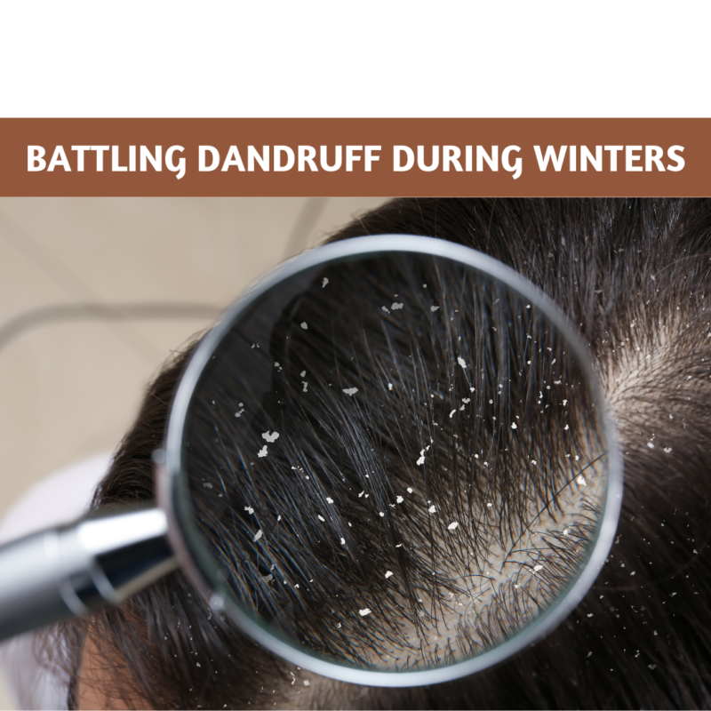 Dandruff during winters