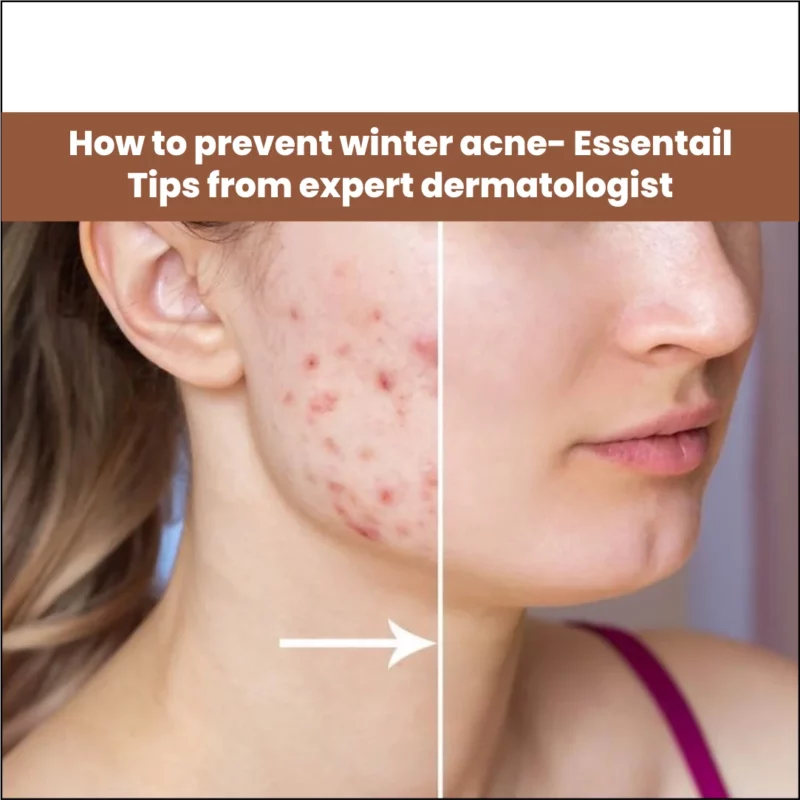 How To Prevent Winter Acne