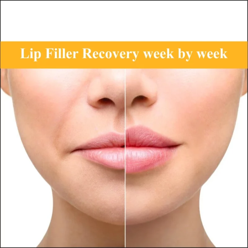 Lip Filler Recovery Week by Week