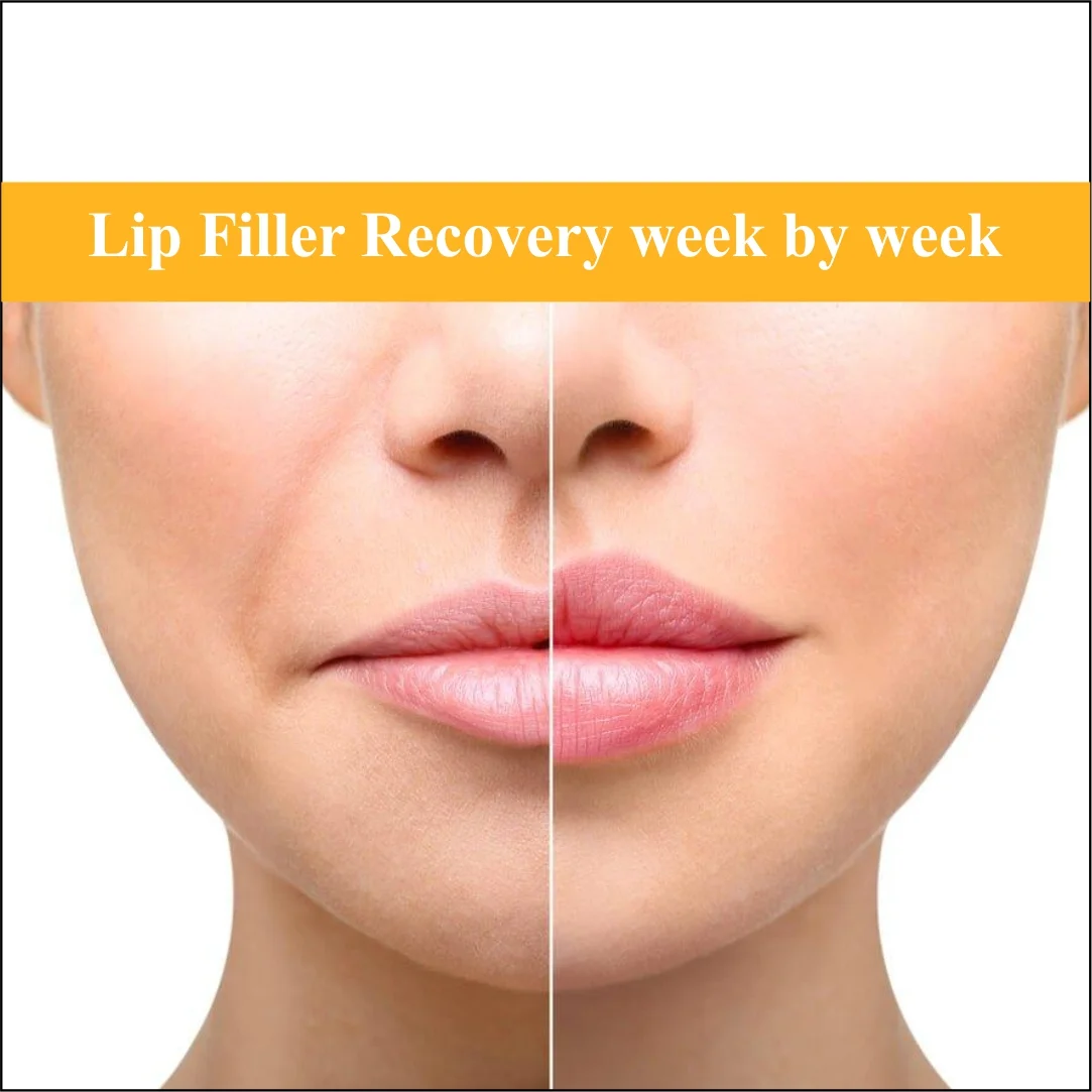 Lip Filler Recovery Week by Week
