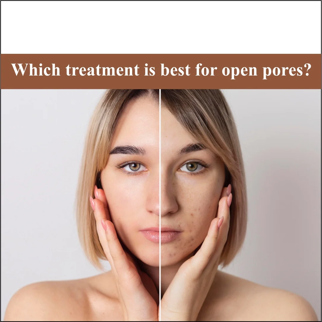 Which Treatment Is Best for Open Pores?