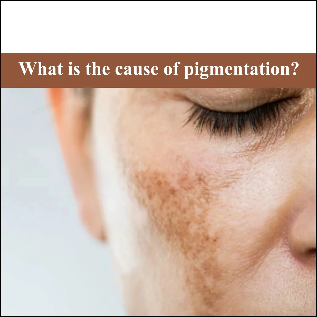What Is The Cause of Pigmentation?