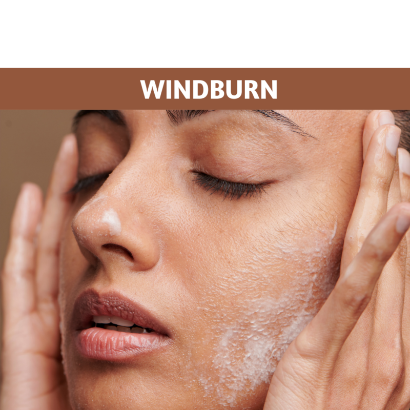 Windburn