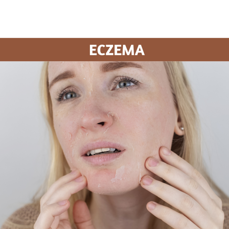 Eczema in winter