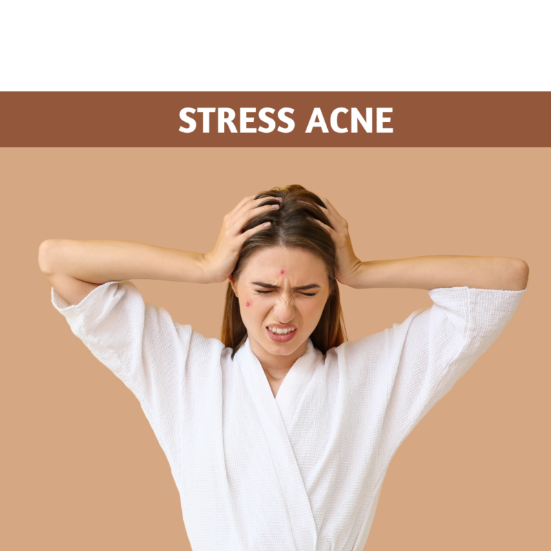 Stress Acne