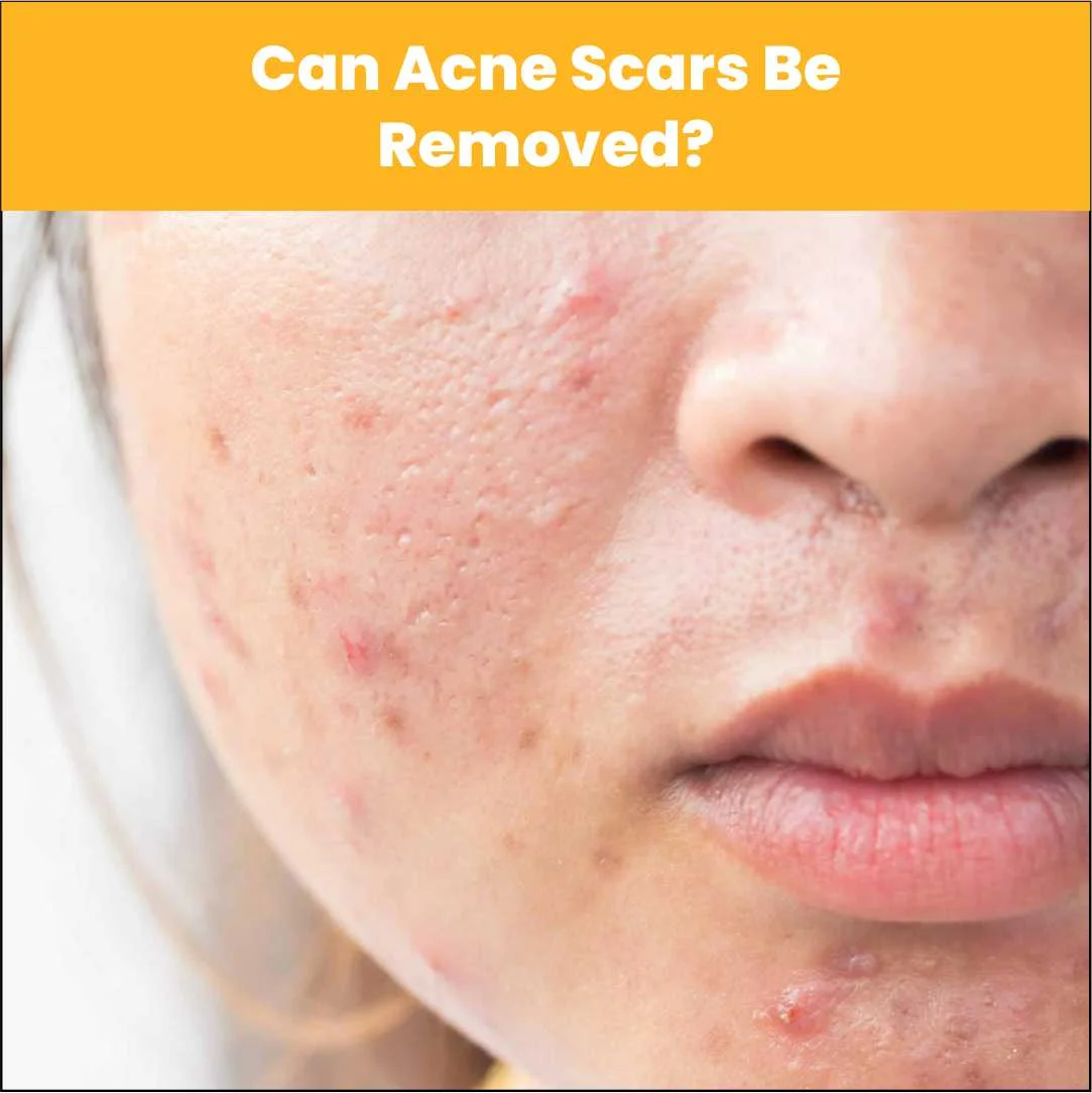 Can Acne Scars Be Removed?
