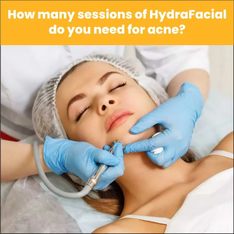 How Many Sessions Of Hydrafacial Do You Need For Acne?