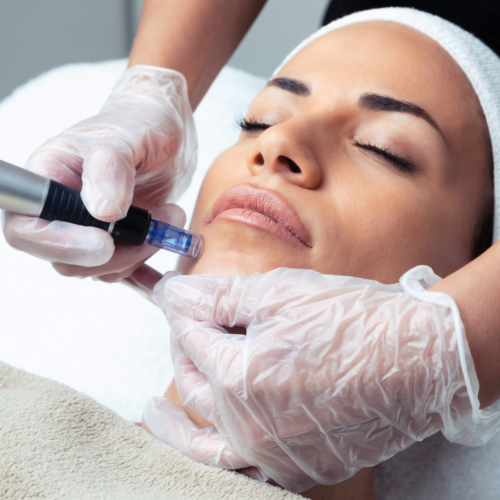 Microneedling for PDRN
