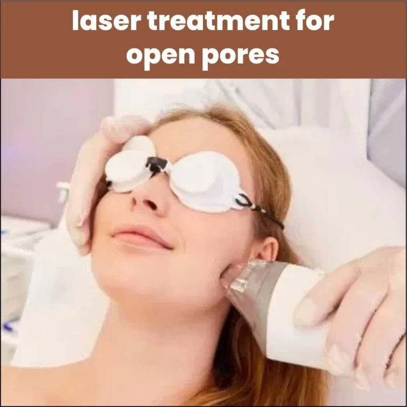 Laser Treatment for Open Pores