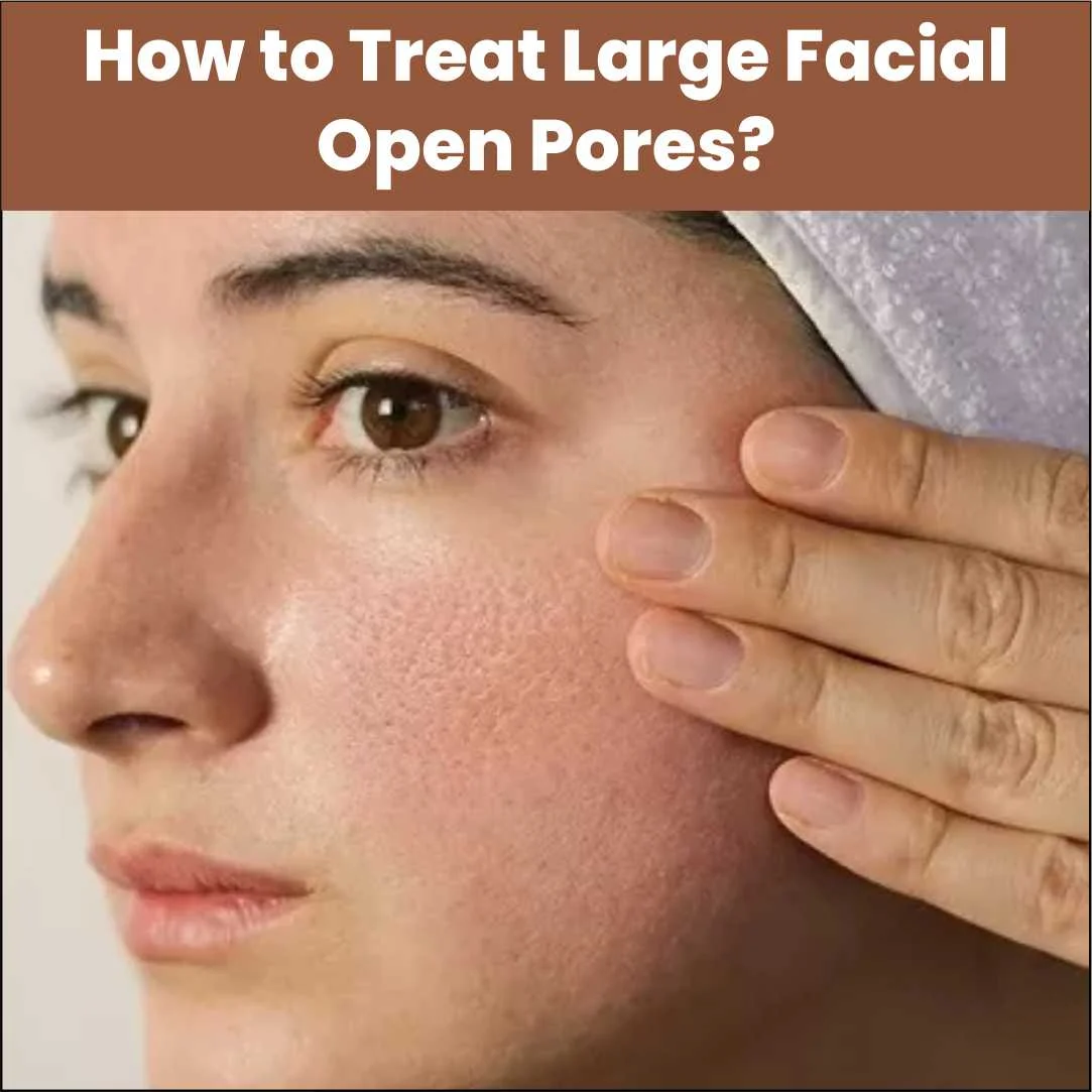 How to Treat Large Facial Open Pores?
