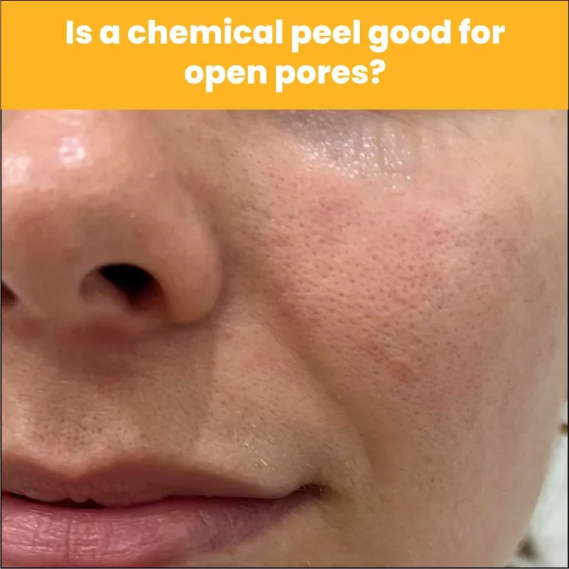 Is A Chemical Peel Good For Open Pores