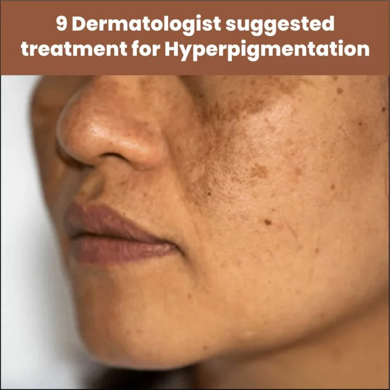 9 Dermatologist Suggested Treatments for Hyperpigmentation