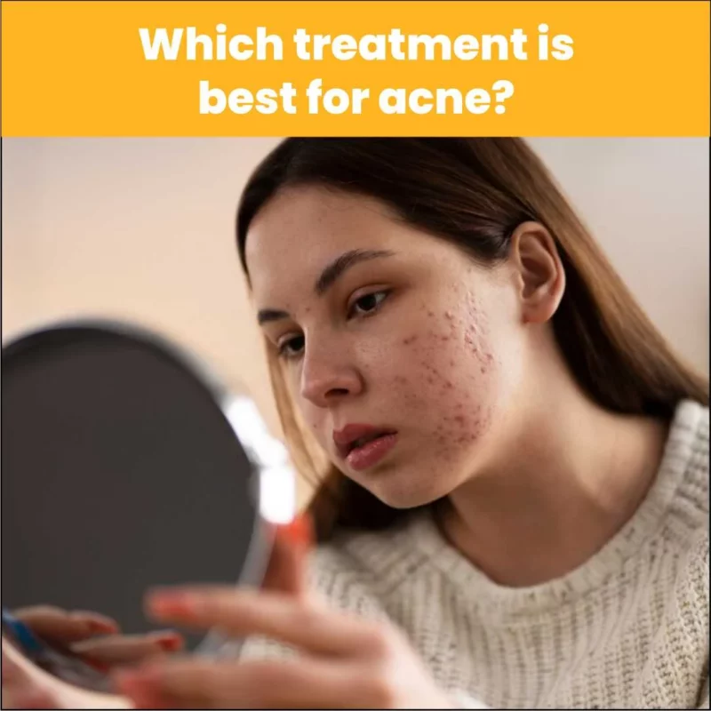 Which Treatment is Best for Acne