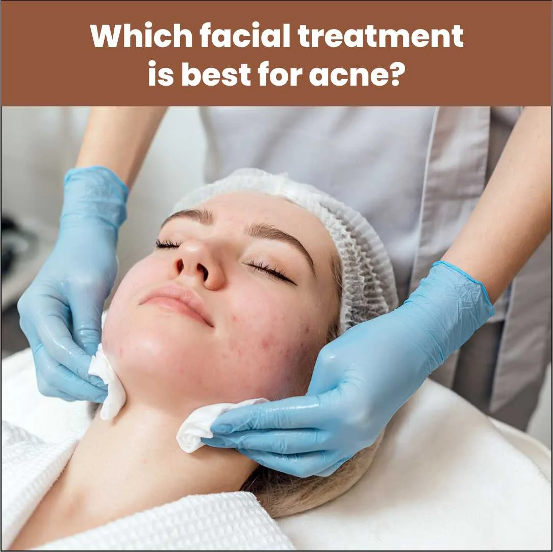 Which Facial Treatment is Best for Acne?