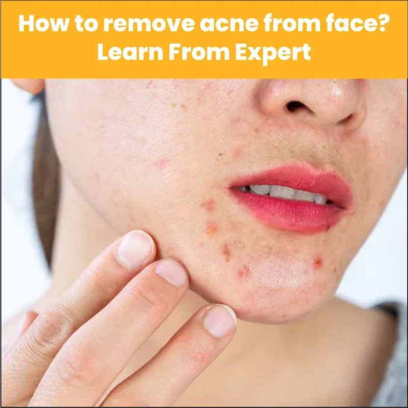 Learn how to remove acne from your face with expert care at AAYNA Clinic. Advanced treatments like peels, lasers, and facials for clear, healthy skin.