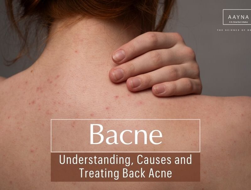 Bacne, Back Acne