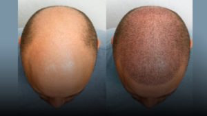 Non-Surgical Hair Replacement in Delhi