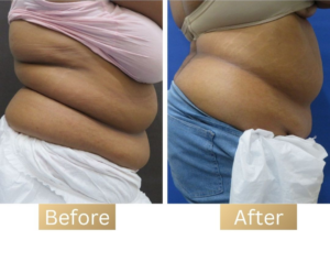 Em-tone & Exilis treatment in delhi